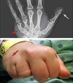 Hand showing skeletal features of Pseudopseudohypoparathyroidism